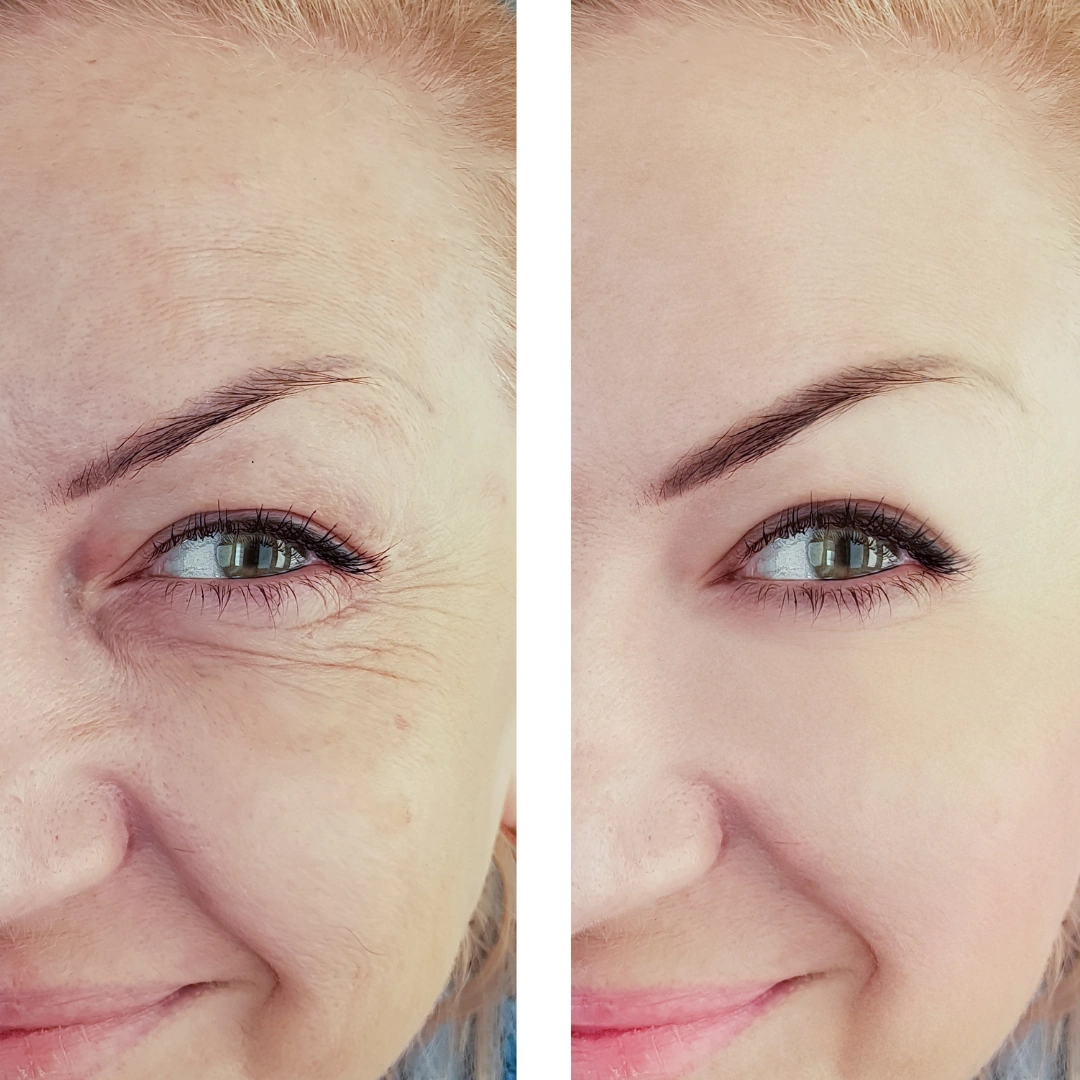 Complete Collagen Plus before and after skin transformation photo